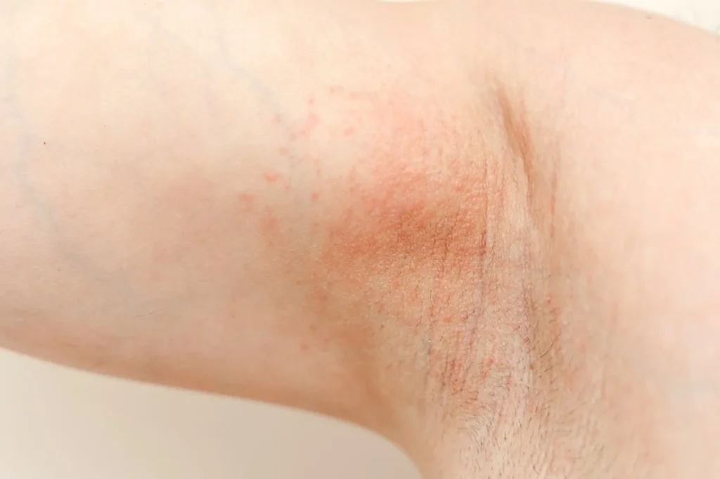 Príznaky alergie na antiperspirant – začervenanie, vyrážka a podráždenie pokožky v podpazuší
